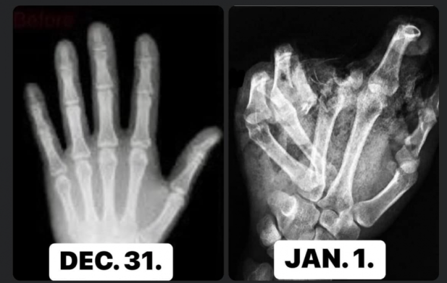 Szétroncsolt kéz röntgenképe - kemény figyelmeztetés