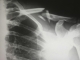 Mit árul el a mellkasi röntgenfelvétel?