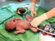 Felgyorsul a kórházakban hagyott újszülöttek örökbefogadási eljárása