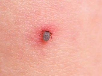 Hogyan néz ki a Lyme-folt, vagyis az erythema migrans?