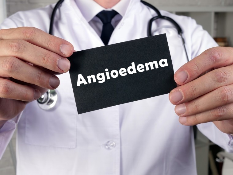 Akár génszerkesztéssel is kezelhetik az angioödémát