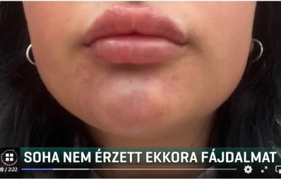 Szájfeltöltés után kórházba került egy 21 éves nő
