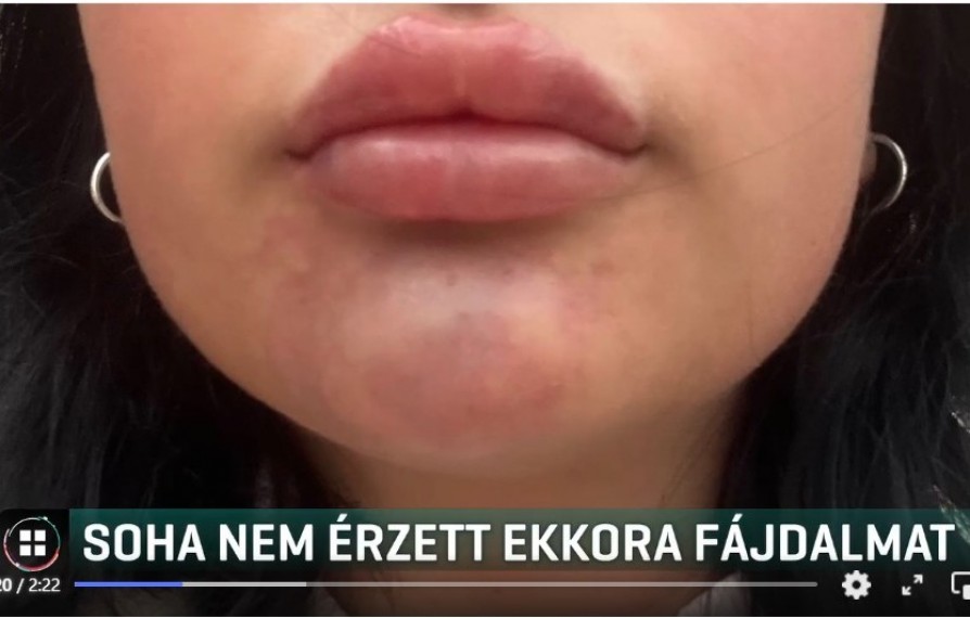 Szájfeltöltés után kórházba került egy 21 éves nő