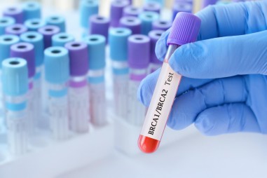Kiknek ajánlott a BRCA-teszt, és mi a jelentősége az onkológiában?