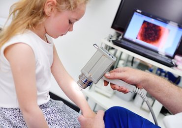 Kislány vírusos szemölcs kezelés