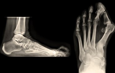 Bütyök és kalapácsujj: miért alakulnak ki és hogyan kezelhetők tartósan?