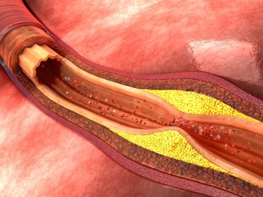 Az érelmeszesedés okát azonosították brit kutatók