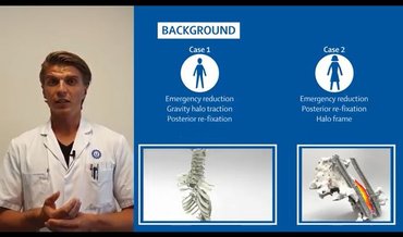 Nyomtatott titánium implantátummal a bénulás ellen