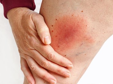 Erythema migrans előfordulása a Lyme-kórban