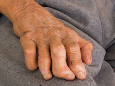 Gyógyítható, de veszélyes: idegenvezető hozta el Bécsbe a leprát