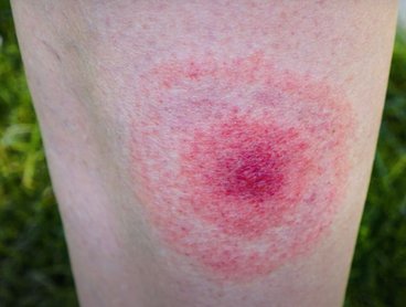 Nem Lyme-kórhoz köthető erythema migrans-szerű bőrtünetek