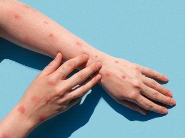 Újabb majomhimlős betegeket azonosítottak itthon