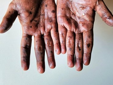 Újabb világjárvány törhet ki, ha nem lépnek