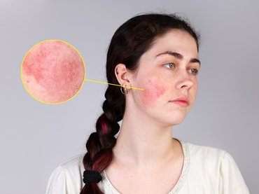 Kipirosodott az orra a tavaszi naptól? Ha rozácea, fontos a kezelés!