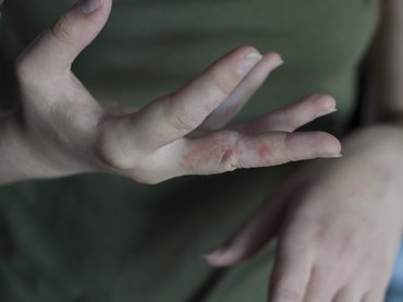 A rühesség napjainkban is globális közegészségügyi probléma