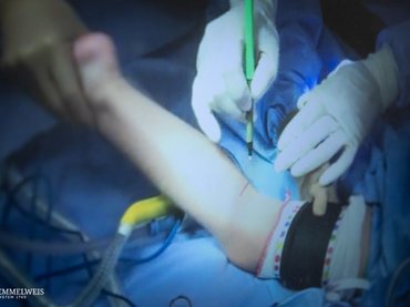 Lábszárból kivett ideget ültettek szembe az SE-n