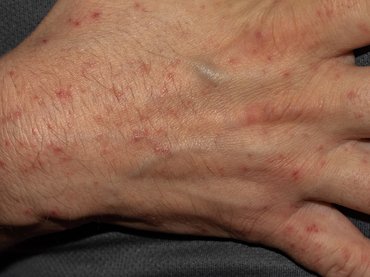 Ritka fertőzések terjednek Észak-Magyarországon