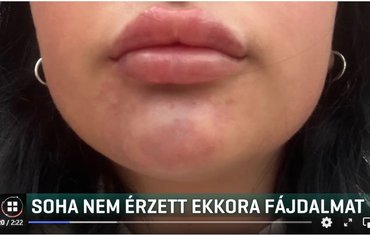 Szájfeltöltés után kórházba került egy 21 éves nő