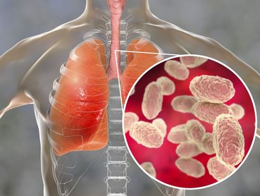 Eddig bagatellizálták a szamárköhögés terjedésének veszélyét