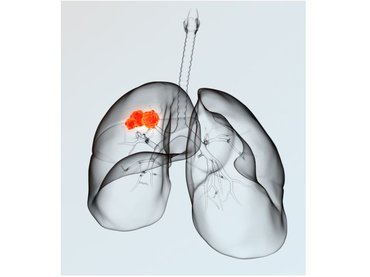 Magyarországon is tesztelik a tüdőrák elleni védőoltást